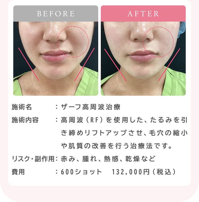 ザーフ高周波治療